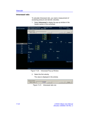 Page 602Vascular
11-42 LOGIQ 5 Basic User Manual
Direction 2300002-100 Rev. 2
Intravessel ratio
To calculate Intravessel ratio, you need a measurement of 
accessing pressure and stenotic velocities.
1. Select Intravessel to display the pop-up window in the 
header section of the worksheet.
 Figure 11-20. Intravessel Pop-up Window
2.  Select the first velocity. 
The value is displayed in the window.
 Figure 11-21. Intravessel ratio one 