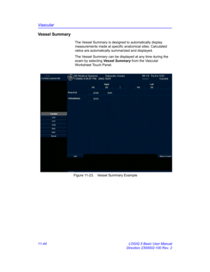 Page 604Vascular
11-44 LOGIQ 5 Basic User Manual
Direction 2300002-100 Rev. 2
Vessel Summary
The Vessel Summary is designed to automatically display 
measurements made at specific anatomical sites. Calculated 
ratios are automatically summarized and displayed.
The Vessel Summary can be displayed at any time during the 
exam by selecting Vessel Summary from the Vascular 
Worksheet Touch Panel.
 Figure 11-23. Vessel Summary Example 