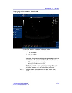 Page 811Preparing for a Biopsy
LOGIQ 5 Basic User Manual 17-29
Direction 2300002-100 Rev. 2
Displaying the Guidezone (continued)
 Figure 17-8. Biopsy Guidezones for the 10L Probe
1.  1 cm increments
2.  5 cm increments
The biopsy guidezone represents a path of the needle. The dots 
which make up the guidezones is the depth readout where: 
•  Yellow represent 1 cm increments. 
•  Red represents 5 cm increments.
The display should be carefully monitored during a biopsy for 
any needle deviation from the center...