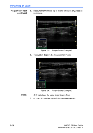 Page 68Performing an Exam
2-24 LOGIQ E9 User Guide
Direction 5180302-100 Rev. 1 Plaque Score Tool
(continued)5.  Measure the thickness (up to twenty times) on any place as 
necessary.
Figure 2-5. Plaque Score Example 2
6.  The system displays the measurement result.
Figure 2-6. Plaque Score Example 3
NOTE:  Only calculates the value larger than 1.1mm.
7.  Double click the Set key to finish the measurement. 